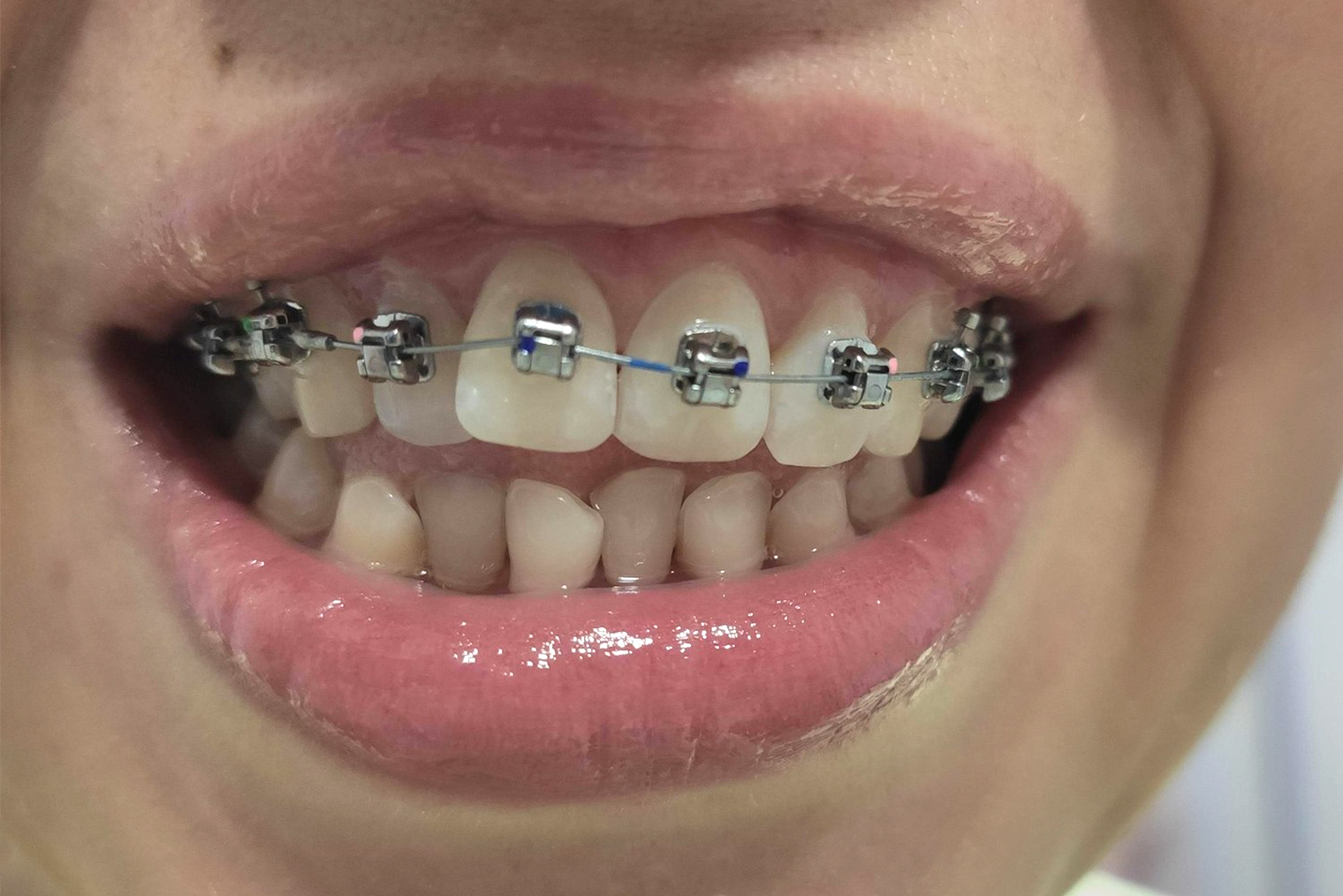 Сразу после установки брекетов на верхнюю челюсть