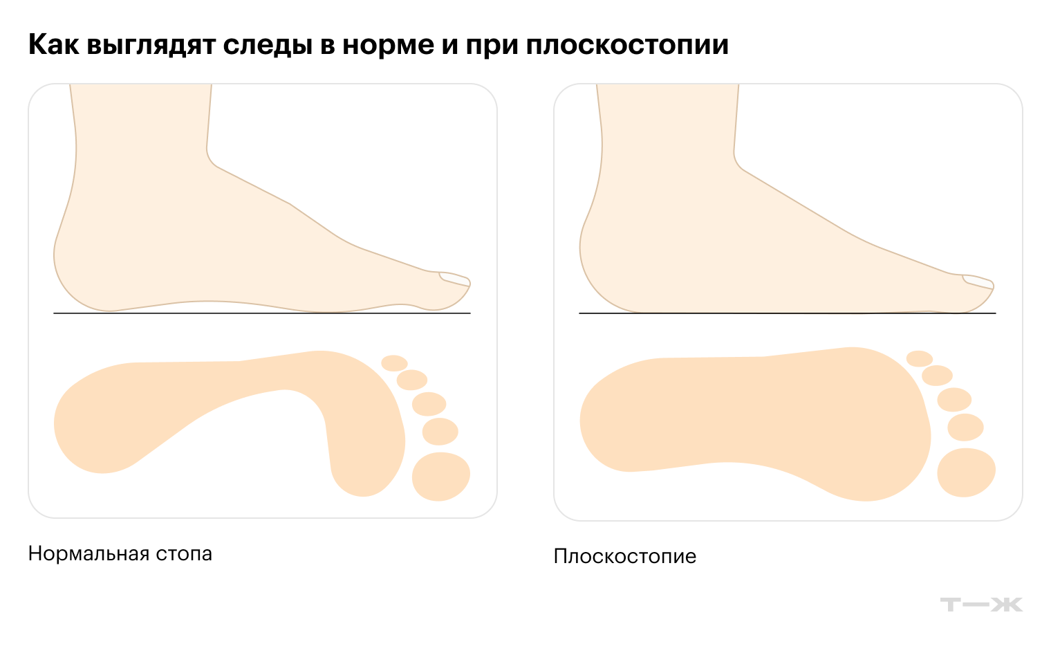 С возрастом даже нормальная стопа может становиться более плоской — и потому увеличивается в размерах