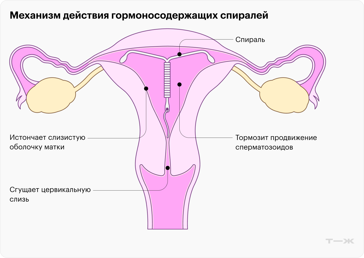 Спираль вводят в полость матки, это может сделать только гинеколог на очном приеме