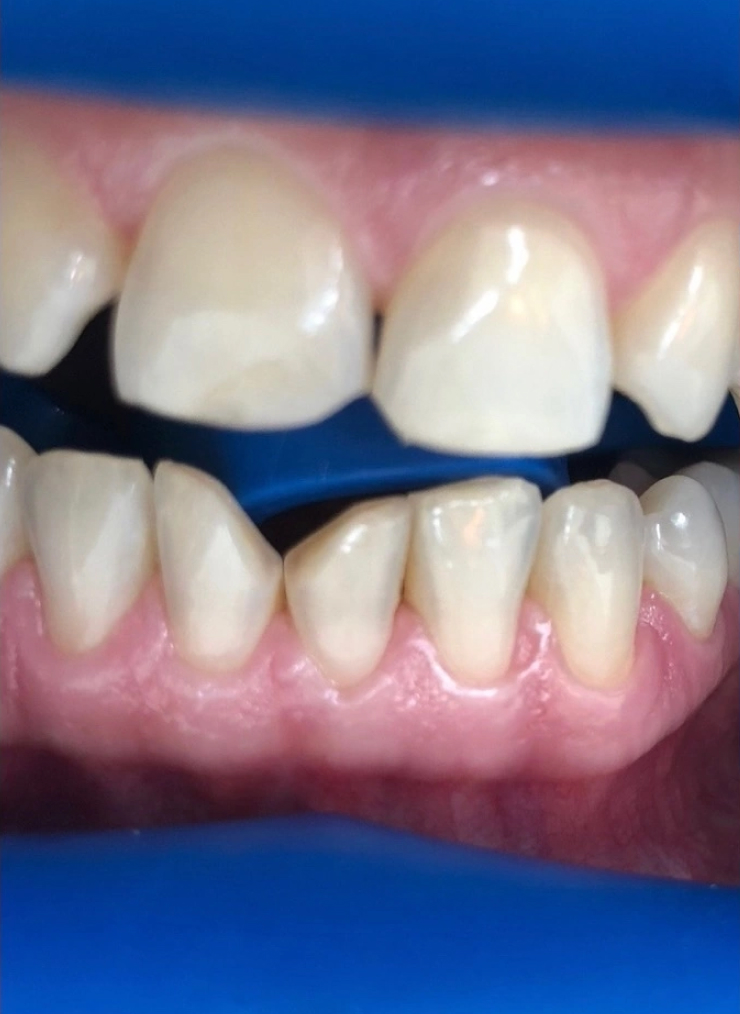 Слева — зубы до отбеливания зубов, справа — после него