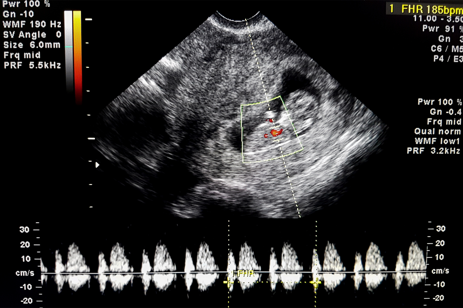 Так на УЗИ смотрят сердцебиение ребенка в утробе матери. Фотография: Monet_3k / Shutterstock / FOTODOM