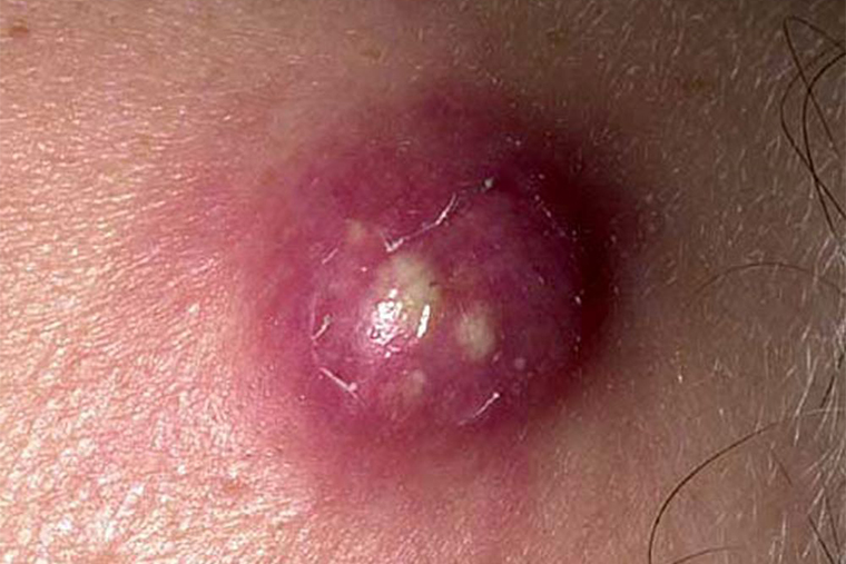 Фурункул больше, чем обыкновенные прыщи. Источник: msdmanuals.com