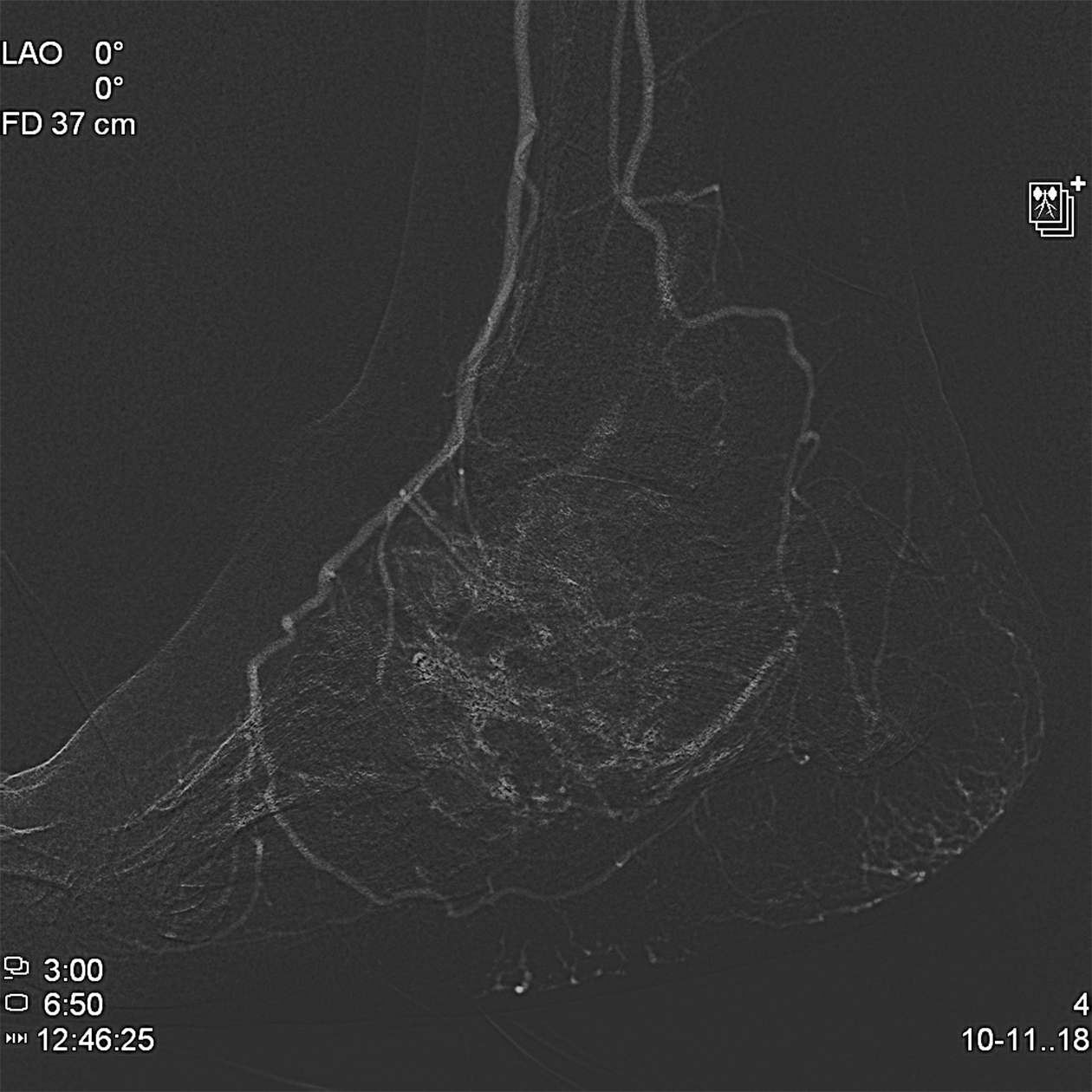 Артериография сосудов стопы. Фотография: Владислав Деркач