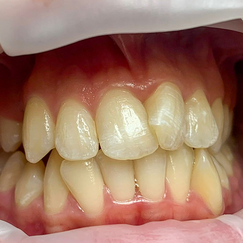 Фотографии зубов, которые сделала ортодонт