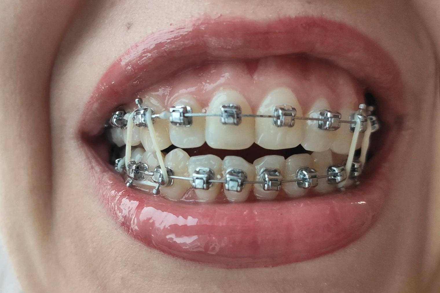 Эластики нужно было крепить в разных комбинациях. Это несложно, но неприятно