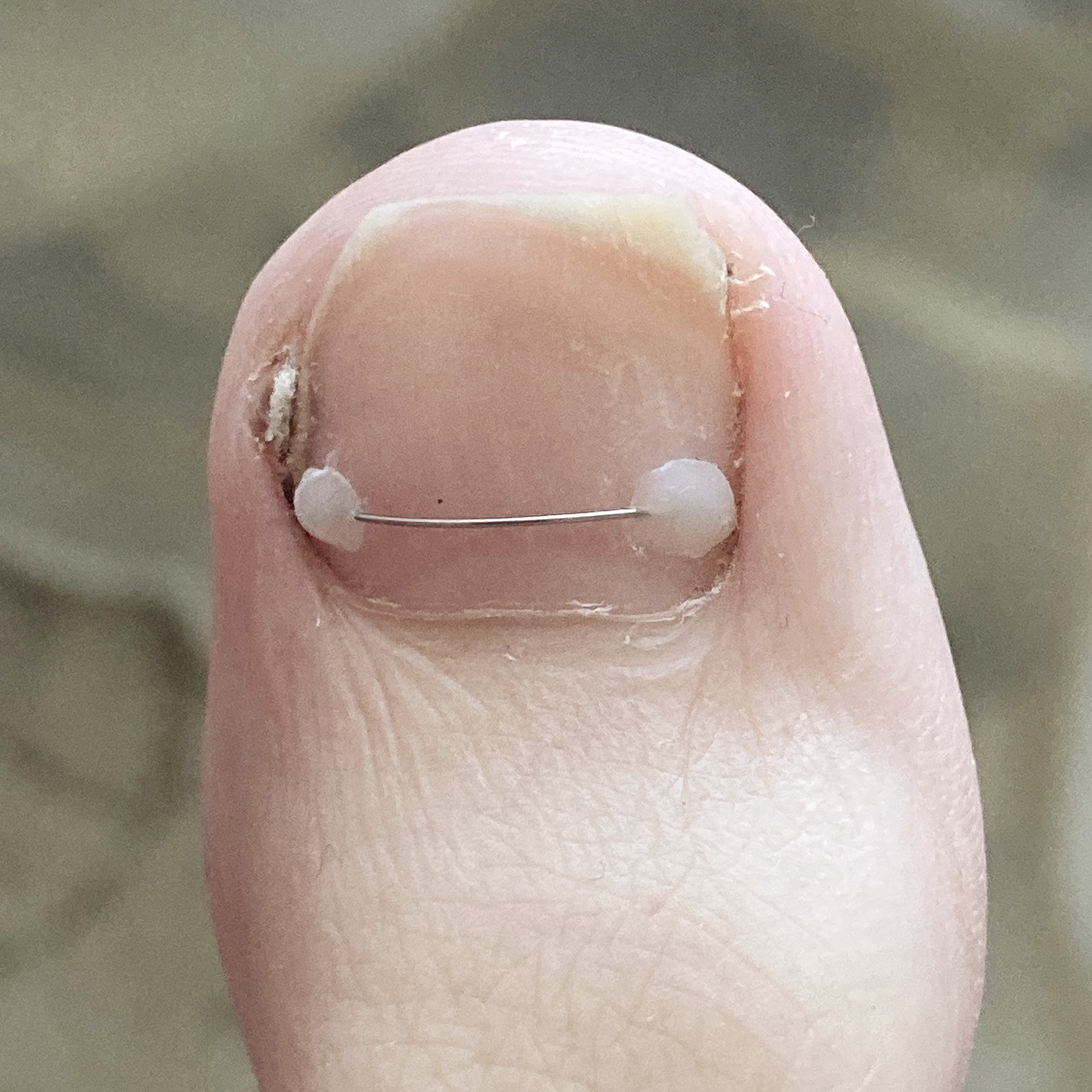 Так выглядит титановая нить. Она не причиняет никакого дискомфорта