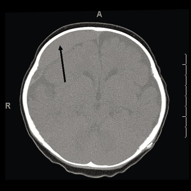Острая субдуральная гематома на КТ головного мозга. Источник: westjem.com