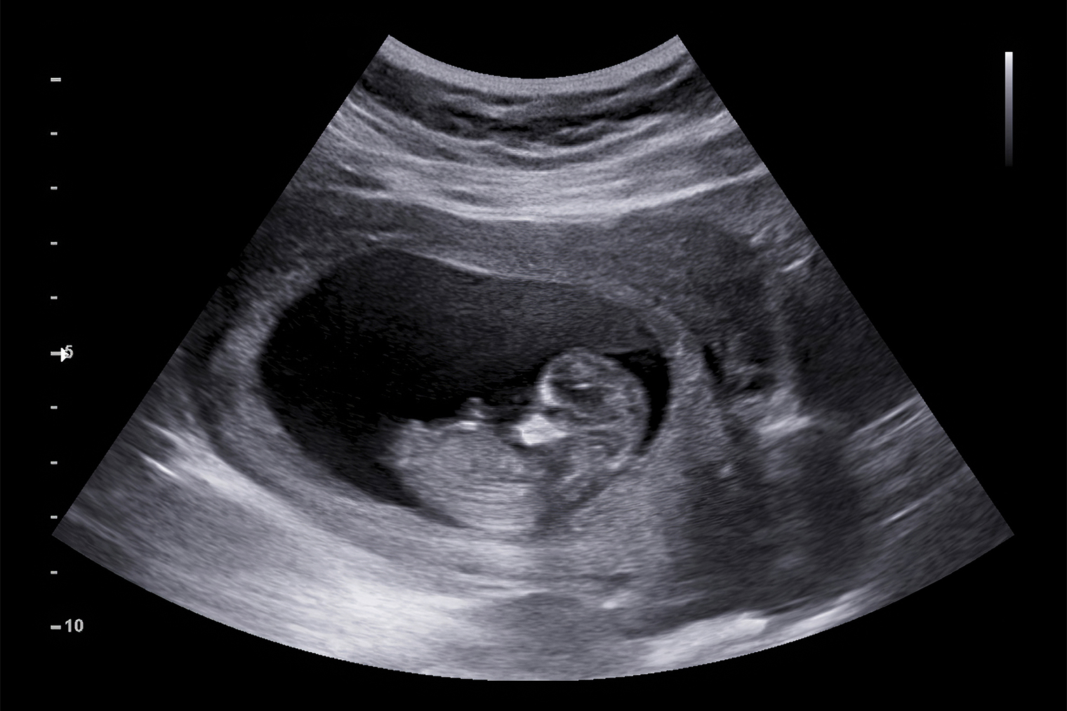 Обычное УЗИ — 12 недель беременности. Фотография: AePatt Journey / Shutterstock / FOTODOM
