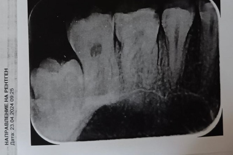 Рентген моих зубов