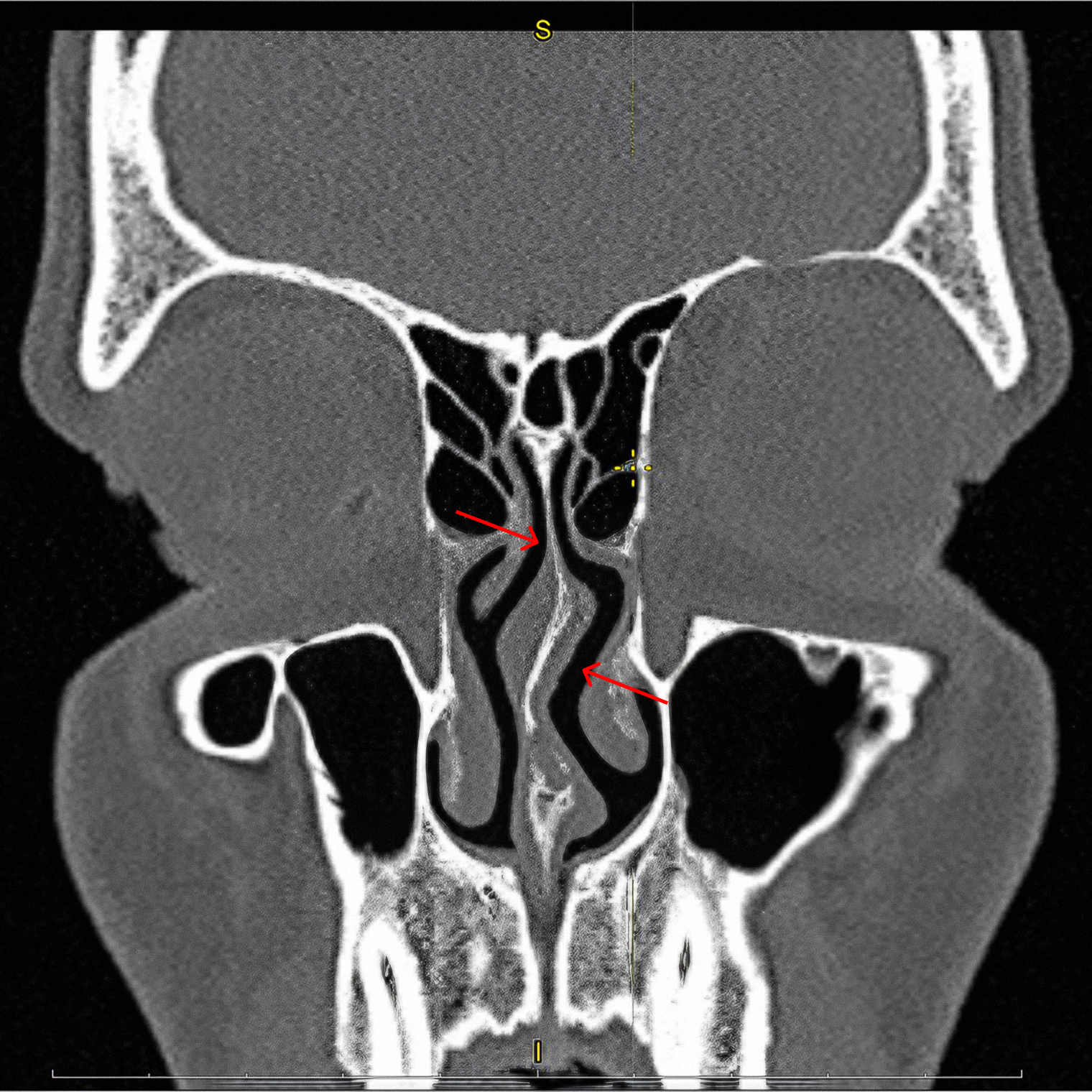 КТ носа до операции. Красные стрелки указывают на искривленную перегородку