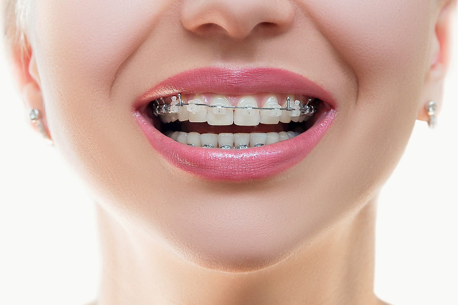 Керамические брекеты все⁠-⁠таки меньше заметны на зубах. Фотография: Alexis C / Shutterstock / FOTODOM