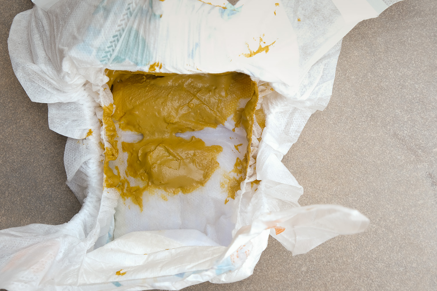 Коричневый стул детей на искусственном питании похож на арахисовое масло. © All_About_Najmi / iStock