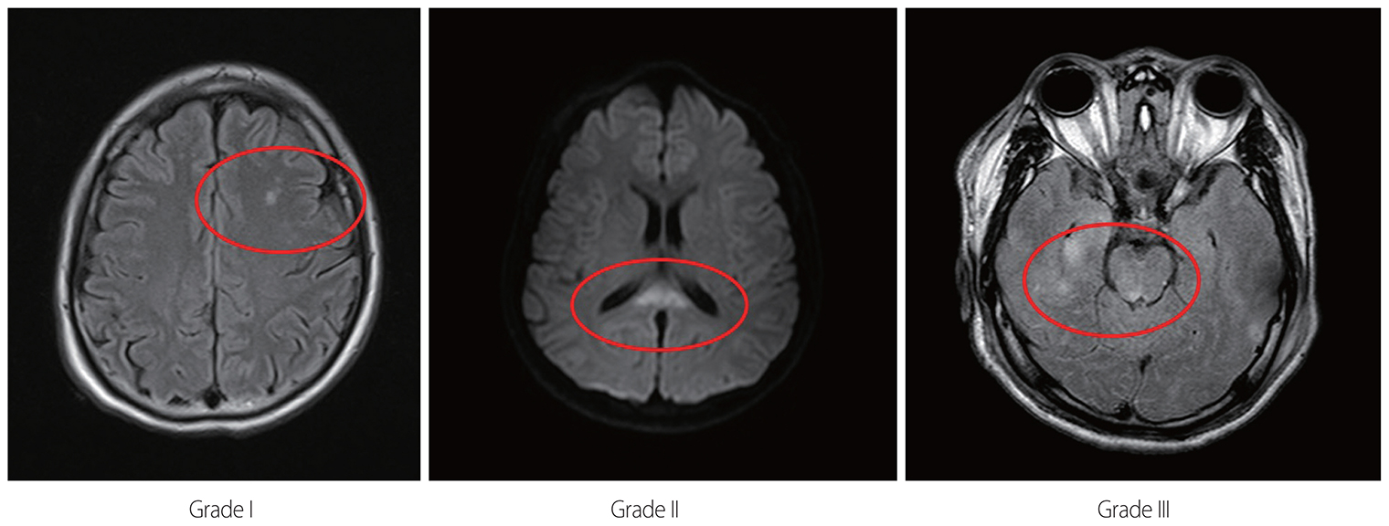 Очаги повреждения головного мозга на МРТ. Источник: jtraumainj.org
