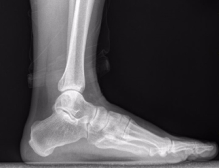 Слева — рентгенограмма стопы в норме, справа — при плоскостопии. Источник: mdpi.com