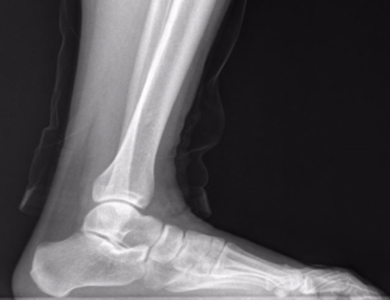 Слева — рентгенограмма стопы в норме, справа — при плоскостопии. Источник: mdpi.com