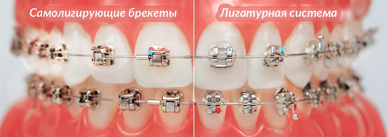 Разница между самолигирующими и лигатурными брекетами есть, но внешне заметна мало. Источник: omnident.ru