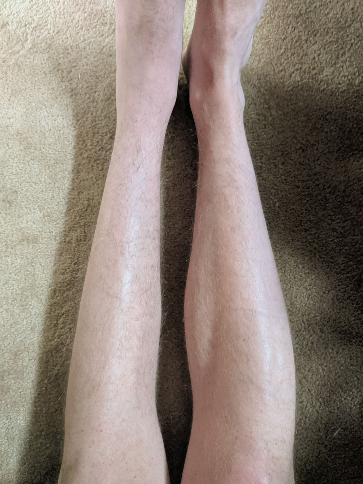 Разница в размере мышц голеней при травме левой ноги. Фотография: AlkalineCosmos / Reddit