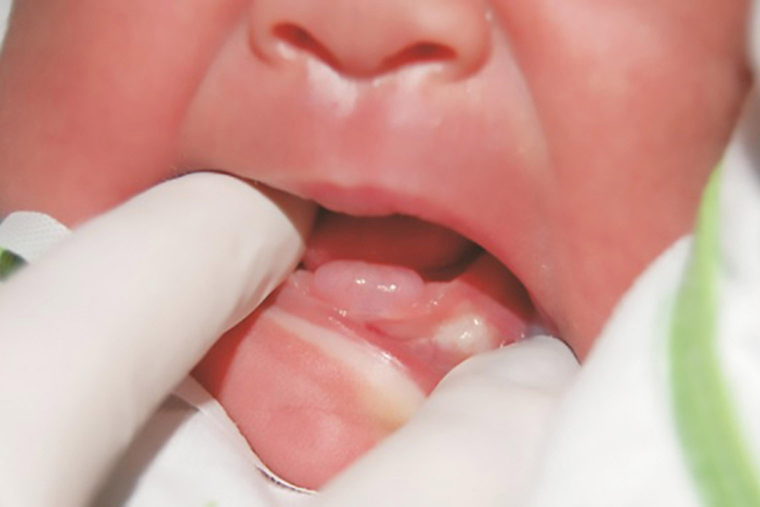 Так выглядит киста, которая может появиться за несколько дней или месяцев до прорезывания зуба. Источник: ncbi.nlm.nih.gov