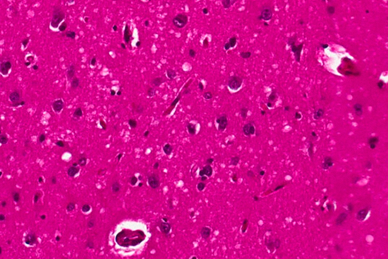 Ткани мозга человека с прионной болезнью, видна губчатая структура. © onlinelibrary.wiley.com