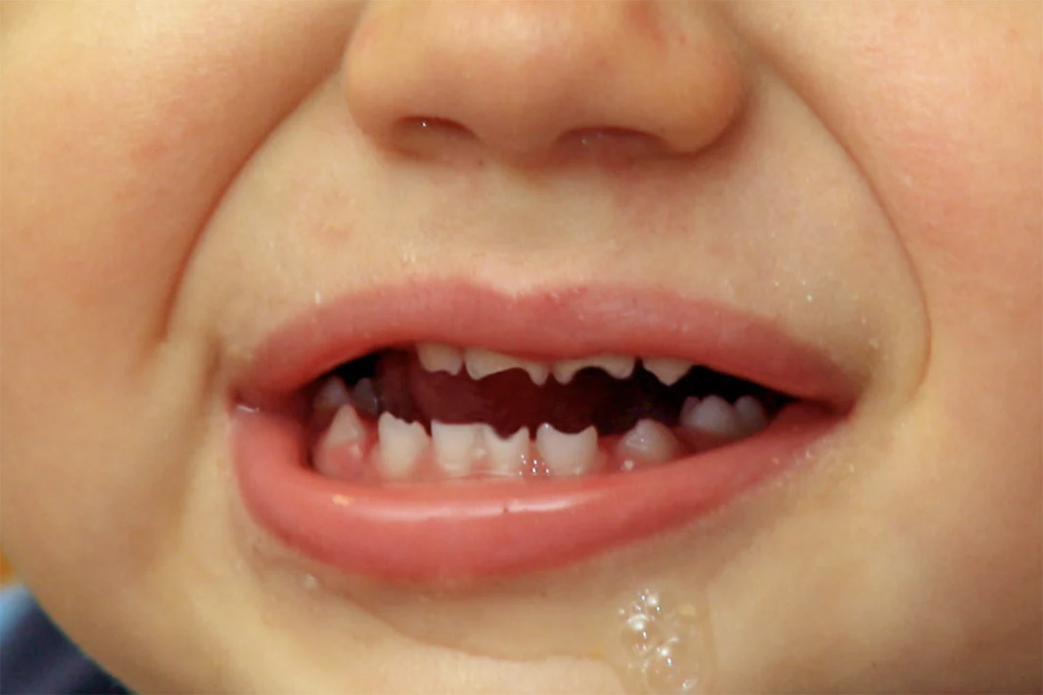 Зазубренные резцы, известные как зубы Хатчинсона, бывают у детей с врожденным сифилисом. Источник: healthline.com