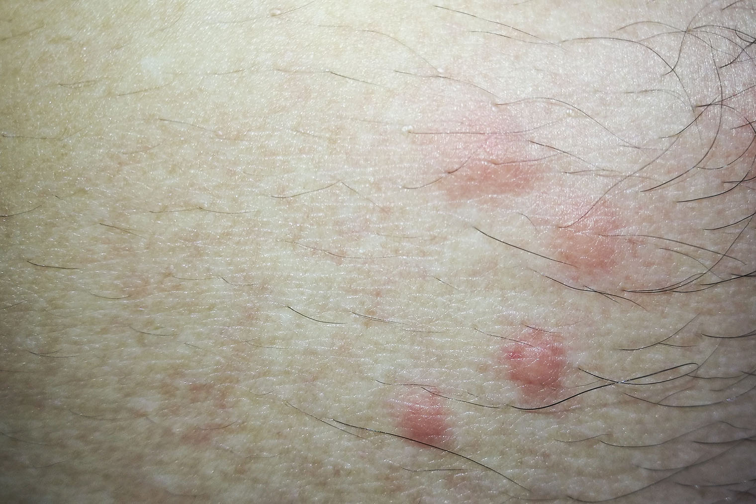 Укусы блох похожи на укусы комаров — это небольшие чуть припухшие красные пятна. Чешутся они так же. Фотография: wiroj Roudkhlay / Shutterstock / FOTODOM