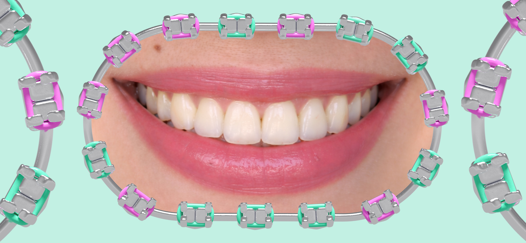 «Дорого, больно, некомфортно, но я снова нравлюсь себе на фото»: как я исправила прикус в 35 лет