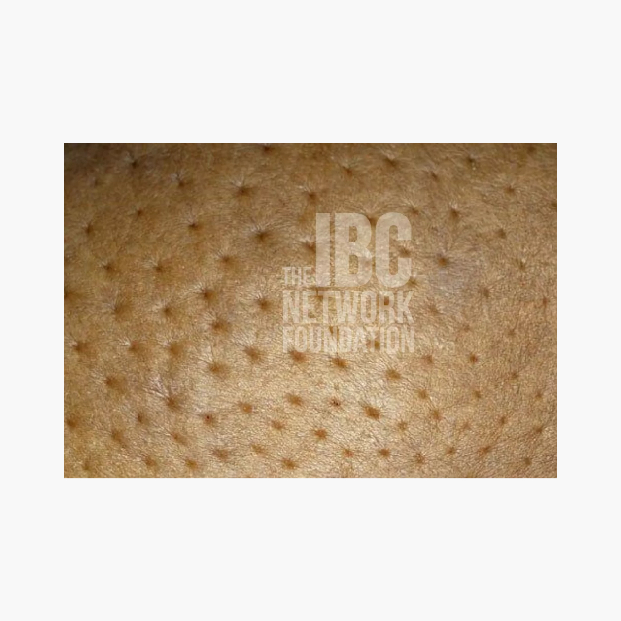 Кожа, которая стала похожа на апельсиновую корку