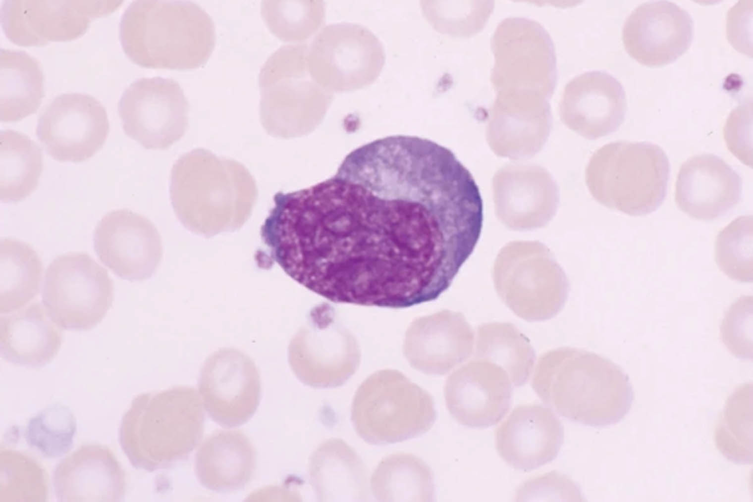При моноцитарном эрлихиозе в крови появляются атипичные лимфоциты. Источник: nature.com