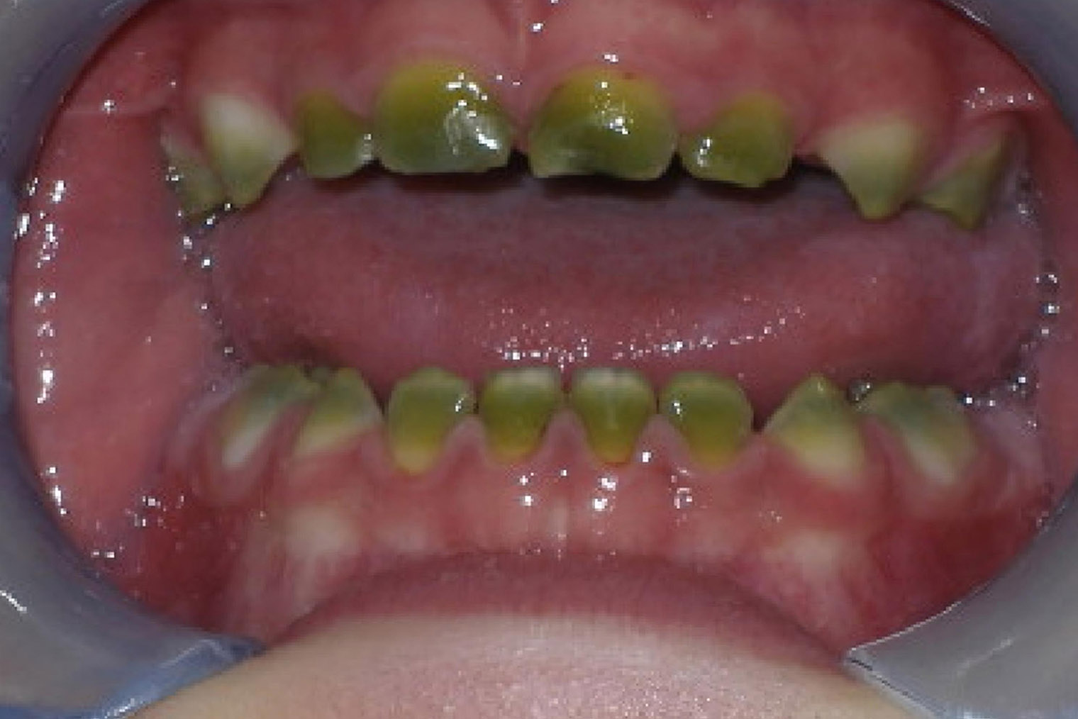 Желто-зеленые зубы младенца, который болел желтухой. Источник: researchgate.net