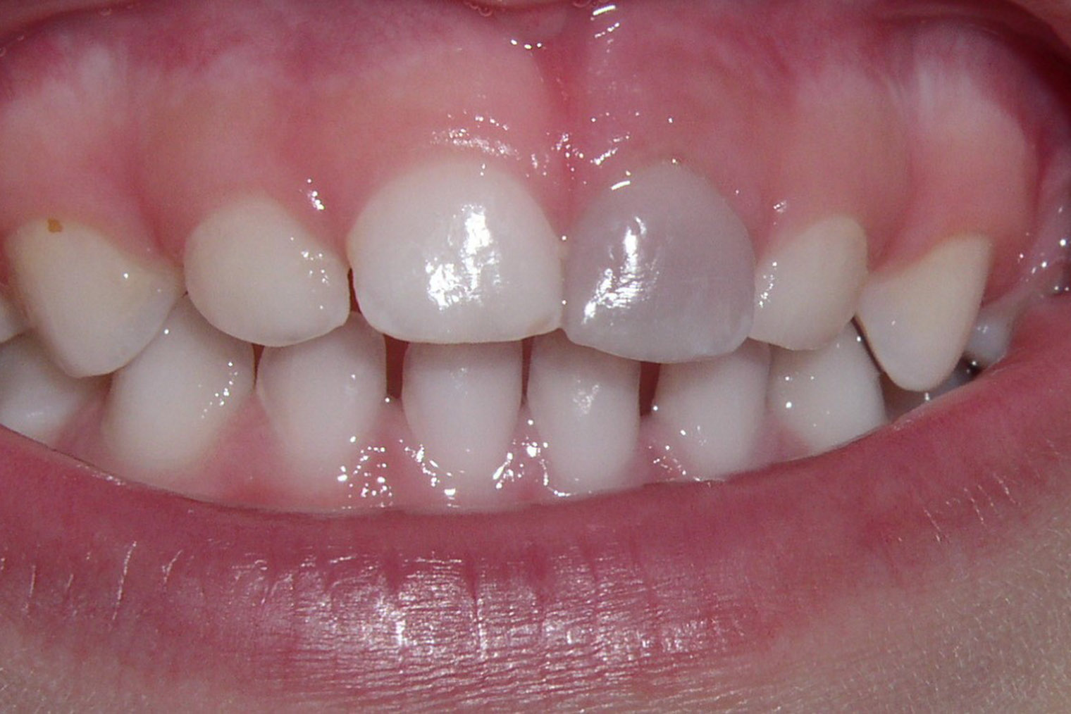 Изменение цвета зуба может быть связано с инфекционным процессом, протекающим внутри него. Источник: pediatricdentistsf.dentist