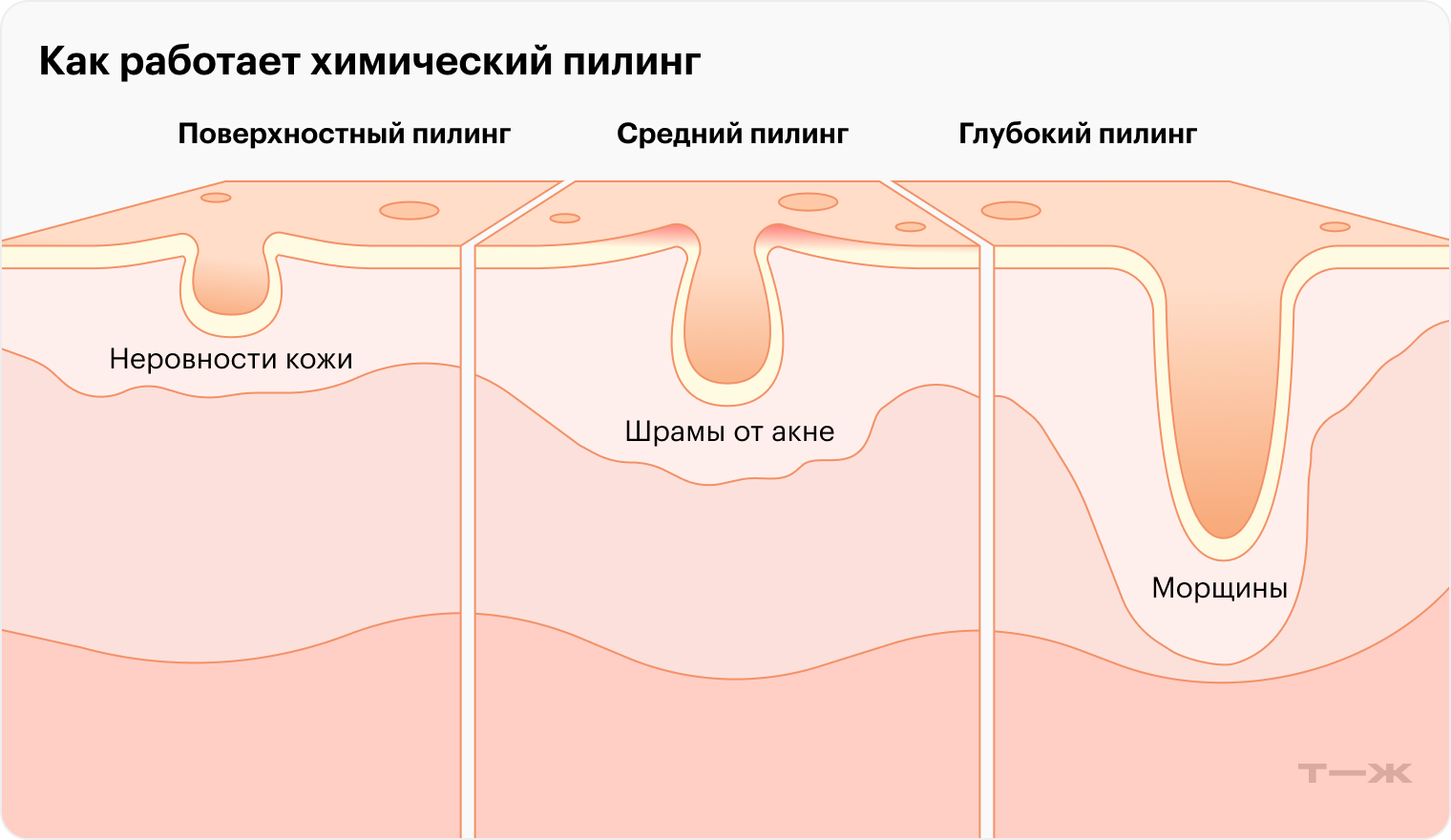 Эффективность кислотного пилинга зависит от его глубины: поверхностные процедуры убирают только незначительные повреждения на коже, а глубокий уже может помочь при умеренных морщинах