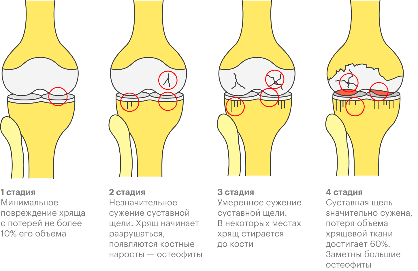 Стадии развития остеоартроза