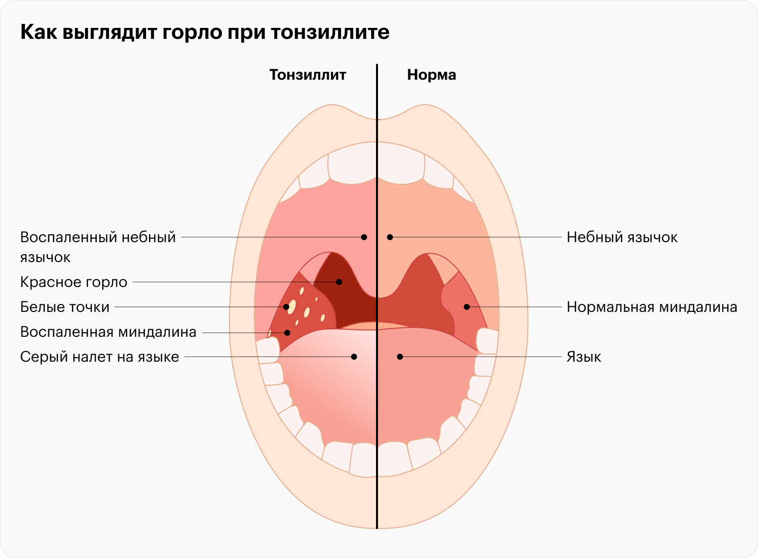 Лечение ангины в Санкт-Петербурге в клинике НЕОМЕД: симптомы, причины, лечение, цены