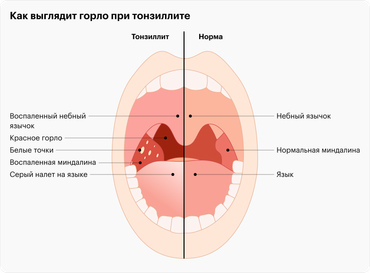 Как лечить гнойную ангину?