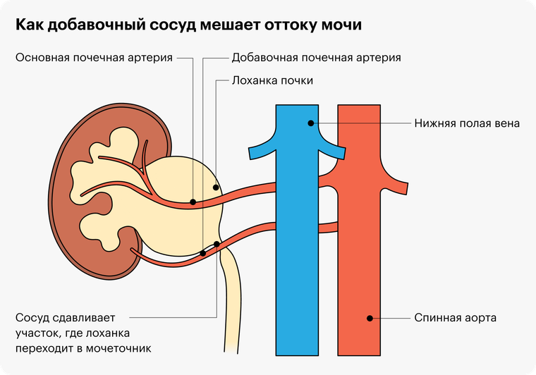 Гидронефроз у детей: почему не стоит затягивать с обращением к врачу