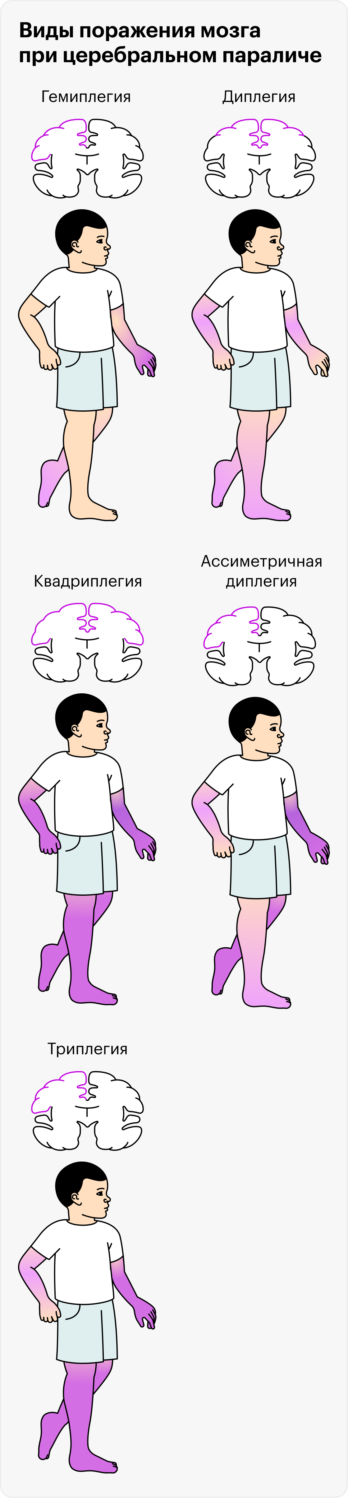 Церебральный паралич проявляется по⁠-⁠разному, в зависимости от того, какой участок мозга поражен и насколько сильно: от гемиплегии, когда движения нарушены в руке и ноге с одной стороны, до квадриплегии, когда человеку с трудом управляет обеими руками и ногами