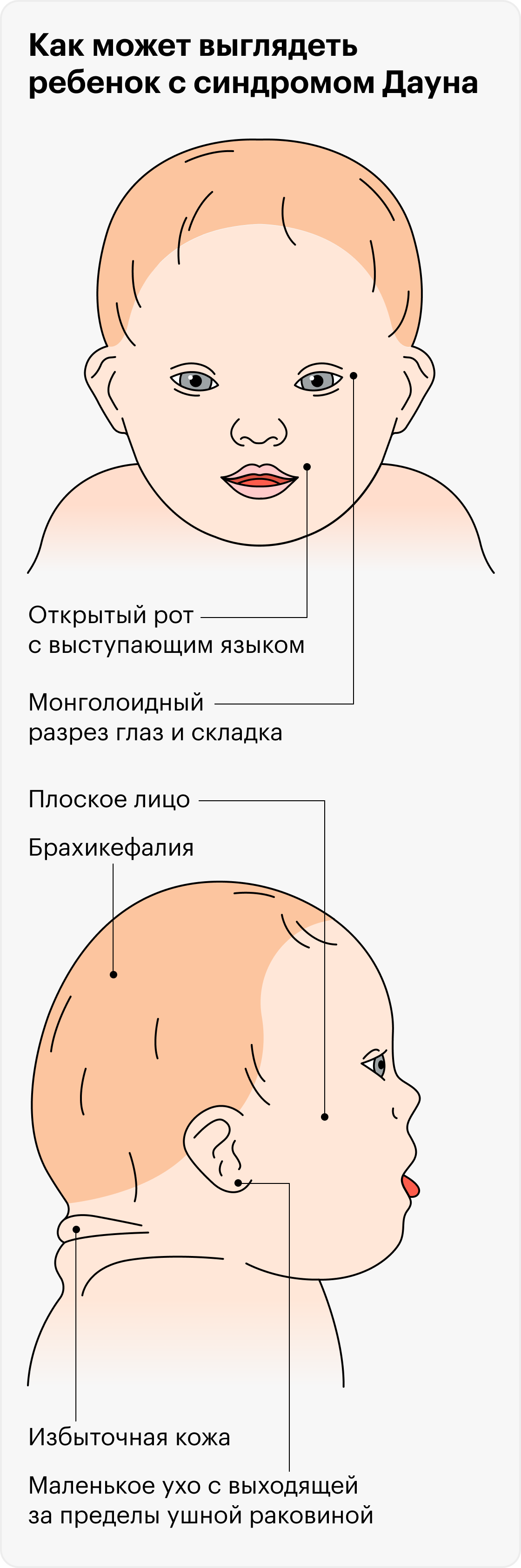 Люди с синдромом Дауна похожи между собой, потому что имеют сходные черты внешности: косой разрез глаз, маленький рот с выступающим языком, маленькие уши, уплощенный затылок и лицо, складки на задней поверхности шеи. Эти черты могут быть выражены в разной степени или отсутствовать совсем