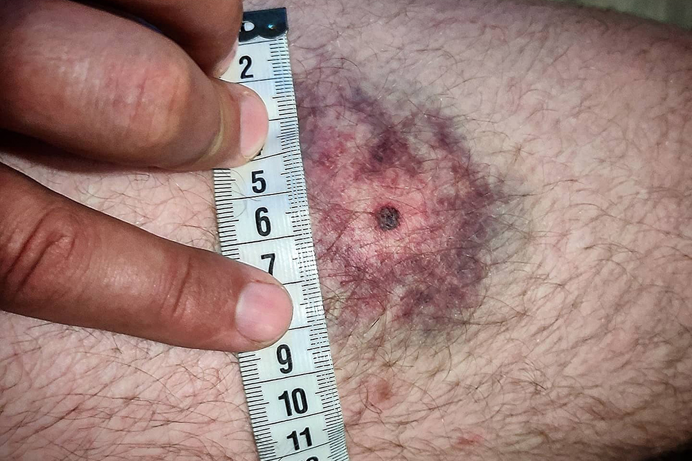 Так выглядит типичный синяк бойца, который пренебрегает минимальной экипировкой