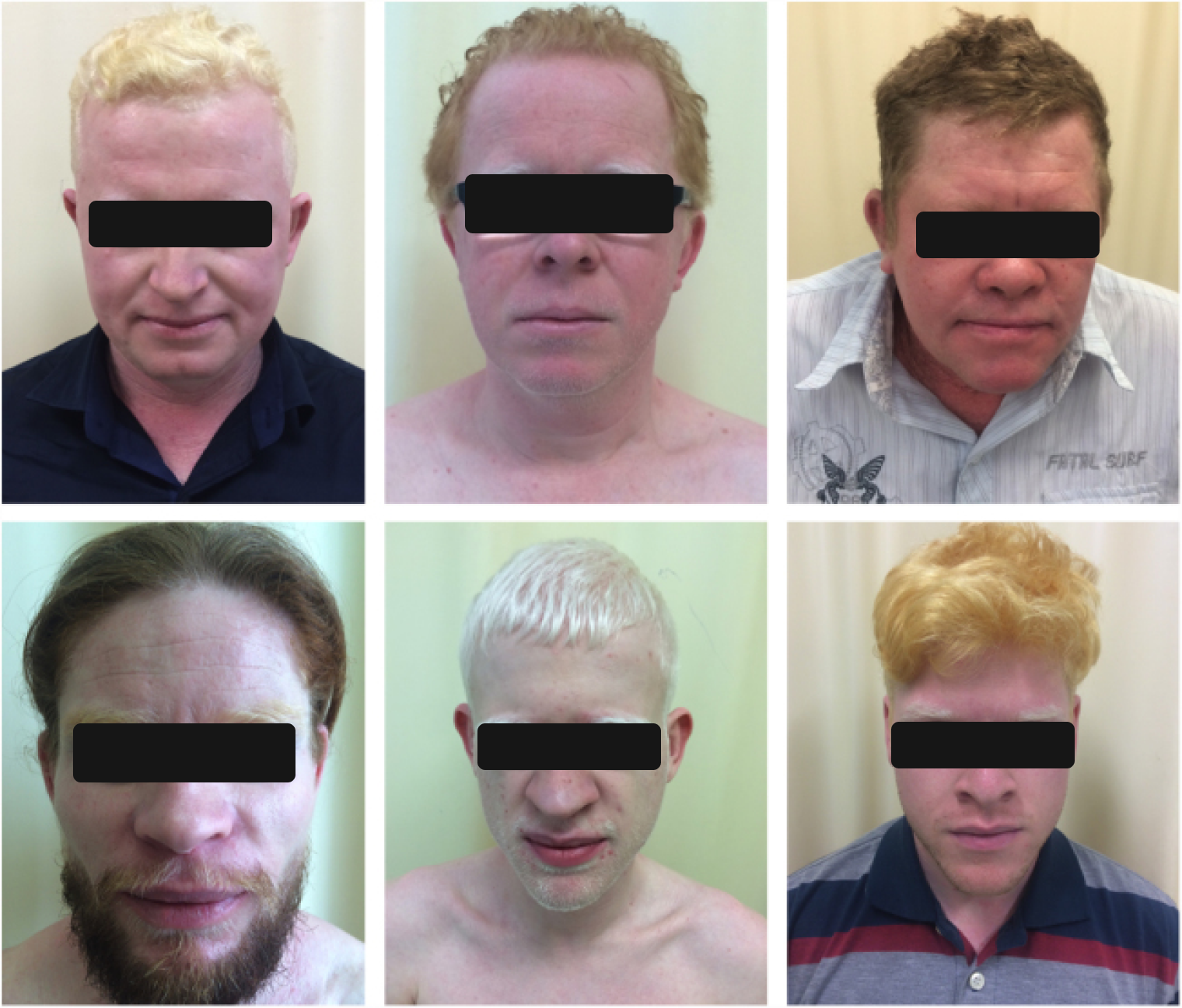 Цвет волос у людей с альбинизмом не всегда белоснежный. Источник: ncbi.nlm.nih.gov