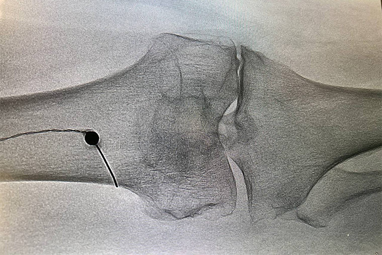 Радиочастотная термическая абляция коленного сустава на рентгене. Фото героя интервью