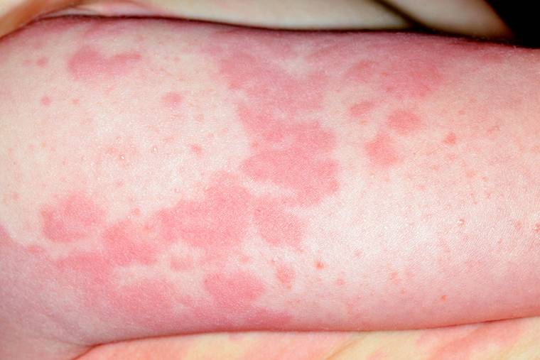 Симптомы аллергии: как проявляется и выглядит аллергия