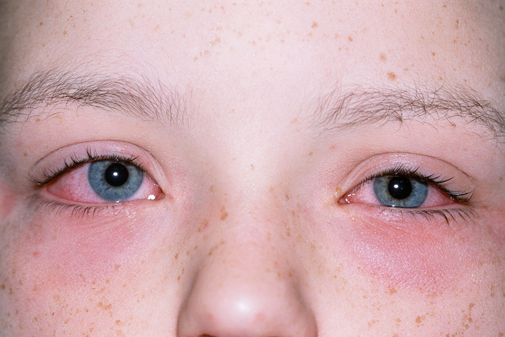 Покрасневшие от аллергии глаза. Фото: сайт NHS