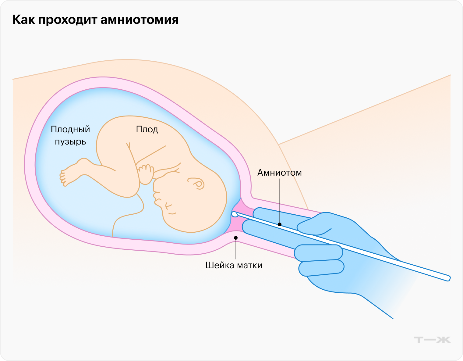 Гинеколог разрывает амниотический мешок специальным крючком, а затем пальцами расширяет надрыв так, чтобы воды стекали постепенно