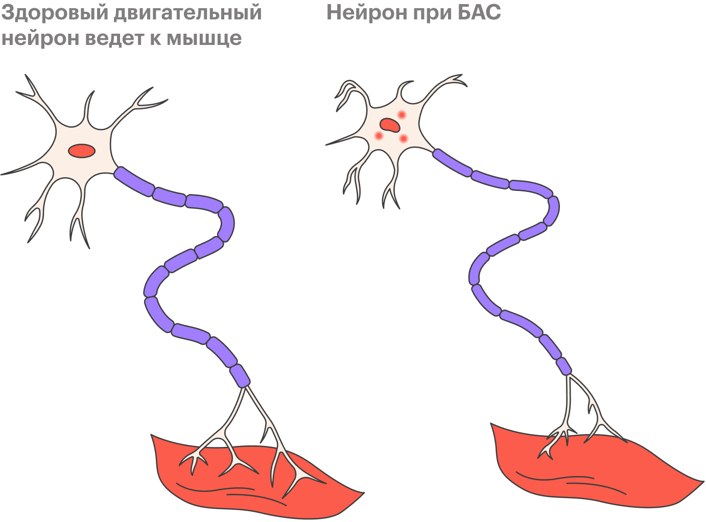БАС поражает два типа нервных клеток: верхние и нижние мотонейроны, которые своими импульсами приводят мышцы в движение. Сначала нейроны ослабевают, затем начинают подергиваться, а после истощаются и отмирают. Именно поэтому на начальных стадиях болезни человеку может быть сложно застегнуть пуговицу, написать что⁠-⁠то или открыть дверь ключом. Потом на разных участках его тела подергиваются мышцы. А затем человек перестает говорить, есть, ходить и дышать