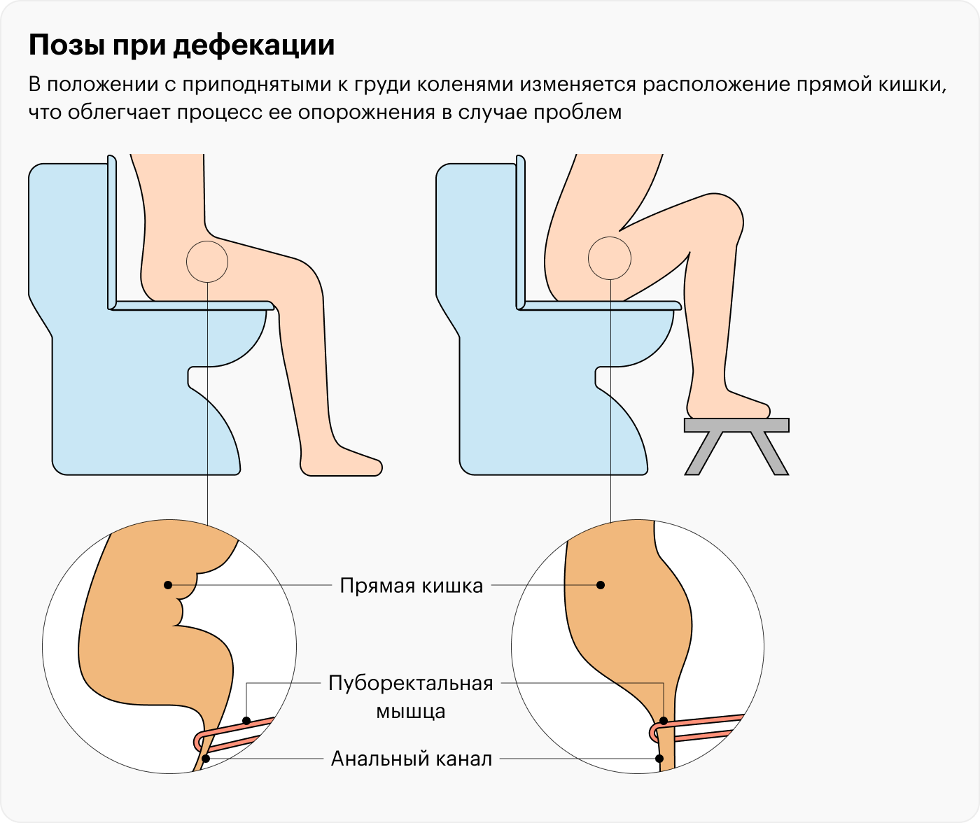 Анальная трещина - лечение острйо хронической трещины в СПб