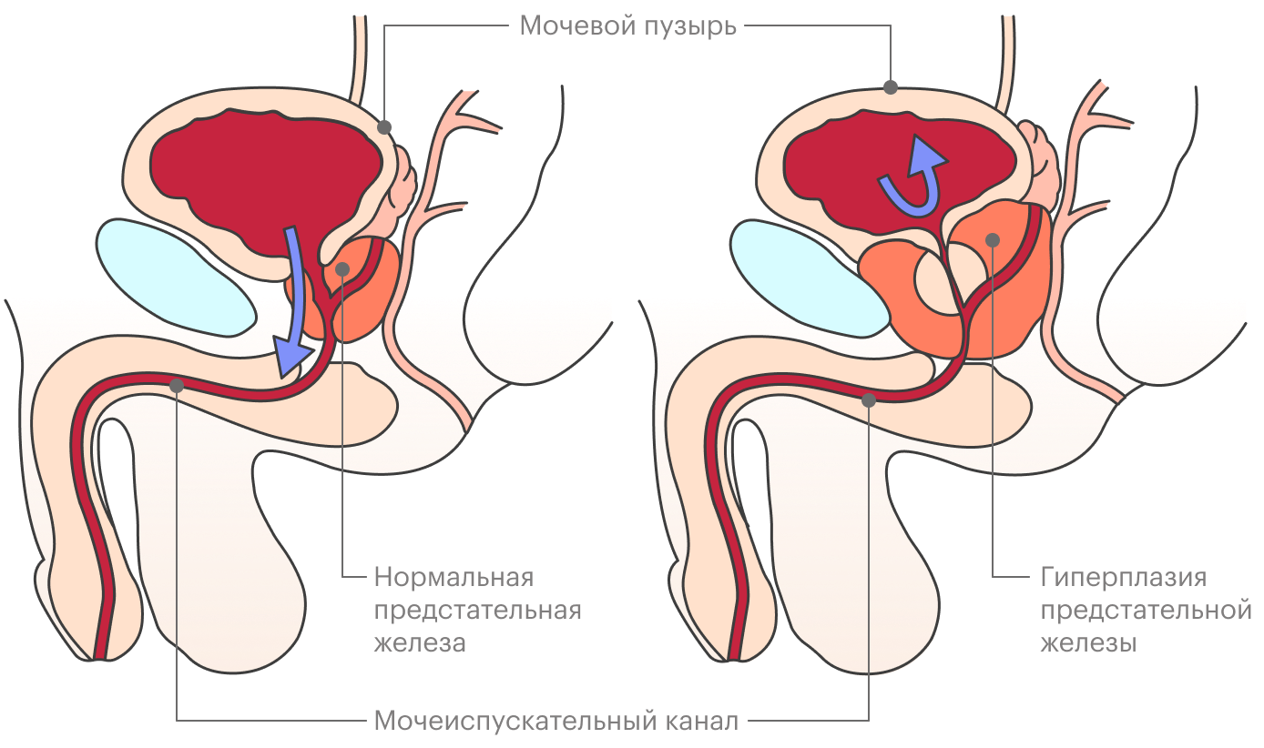 При аденоме предстательной железы она увеличивается и может пережать мочеиспускательный канал