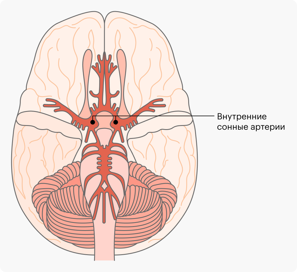 Аневризма артерии головного мозга: причины, симптомы, диагностика, лечение,  стоимость операции по ОМС