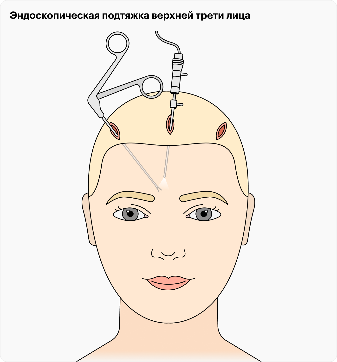 Для эндоскопически-ассистированного омоложения верхней трети лица достаточно небольших проколов, через которые вводят хирургические инструменты и эндоскоп