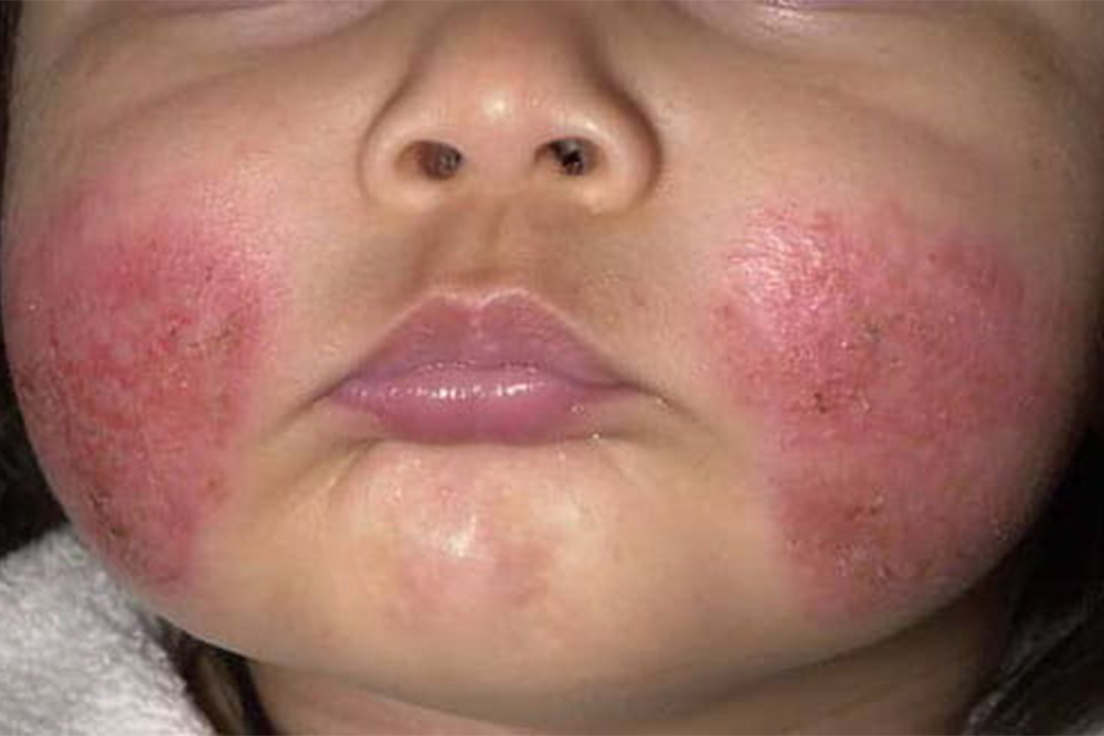 Атопический дерматит у ребенка. Источник: справочник MSD