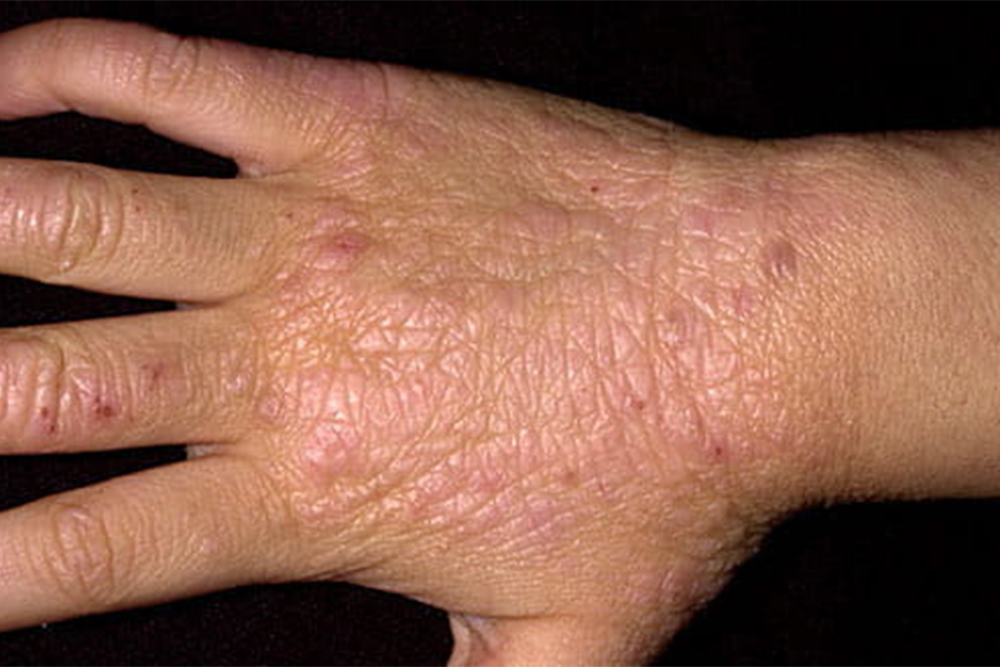 Утолщение кожи при атопическом дерматите. Источник: справочник MSD